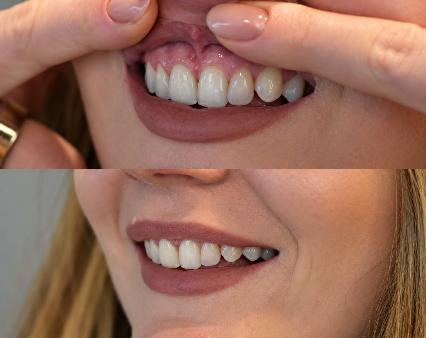 Comparatif de sourire avant après